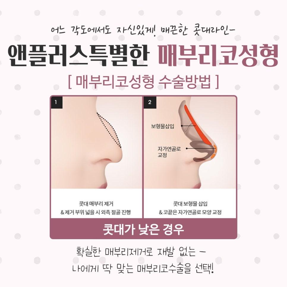 매부리코성형후기 꼼꼼하게 알아보고 관련 이미지 11
