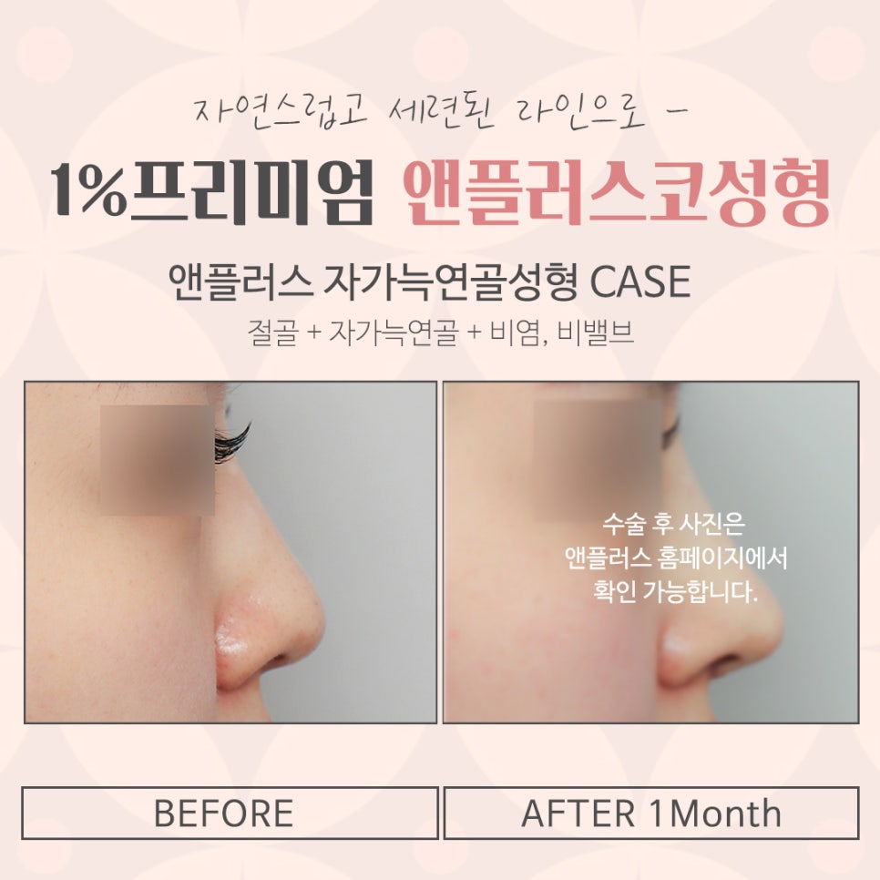 자가늑연골코성형을 통한 이미지 개선 관련 이미지 16