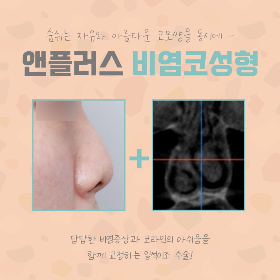오지코에서 알려드리는 비염코수술 관련 이미지 4