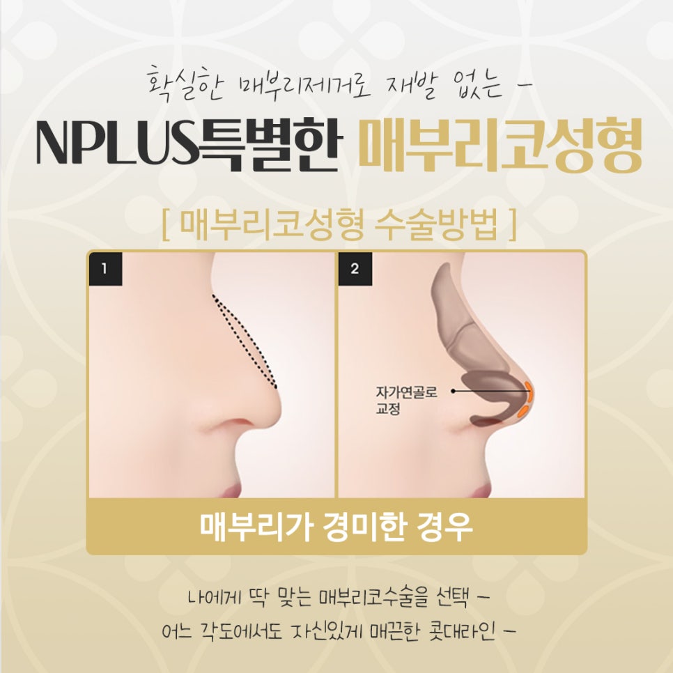 매부리코수술후기 확실하게 확인하여 관련 이미지 10
