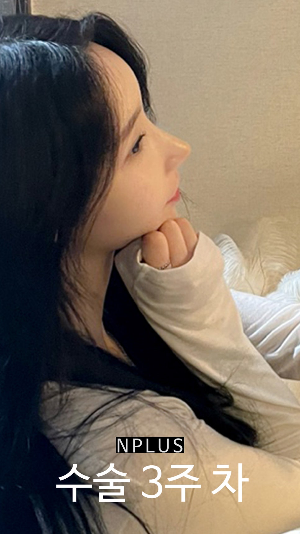 기본코성형후기 절골 + 무보형물 코성형 + 코끝 비중격 연골, 귀 연골 관련 이미지 7