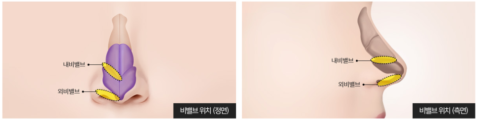 비염의 원인과 해결 방법! 관련 이미지 18