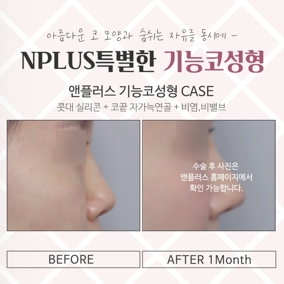 한쪽코막힘을 해결하는 방법 관련 이미지 13