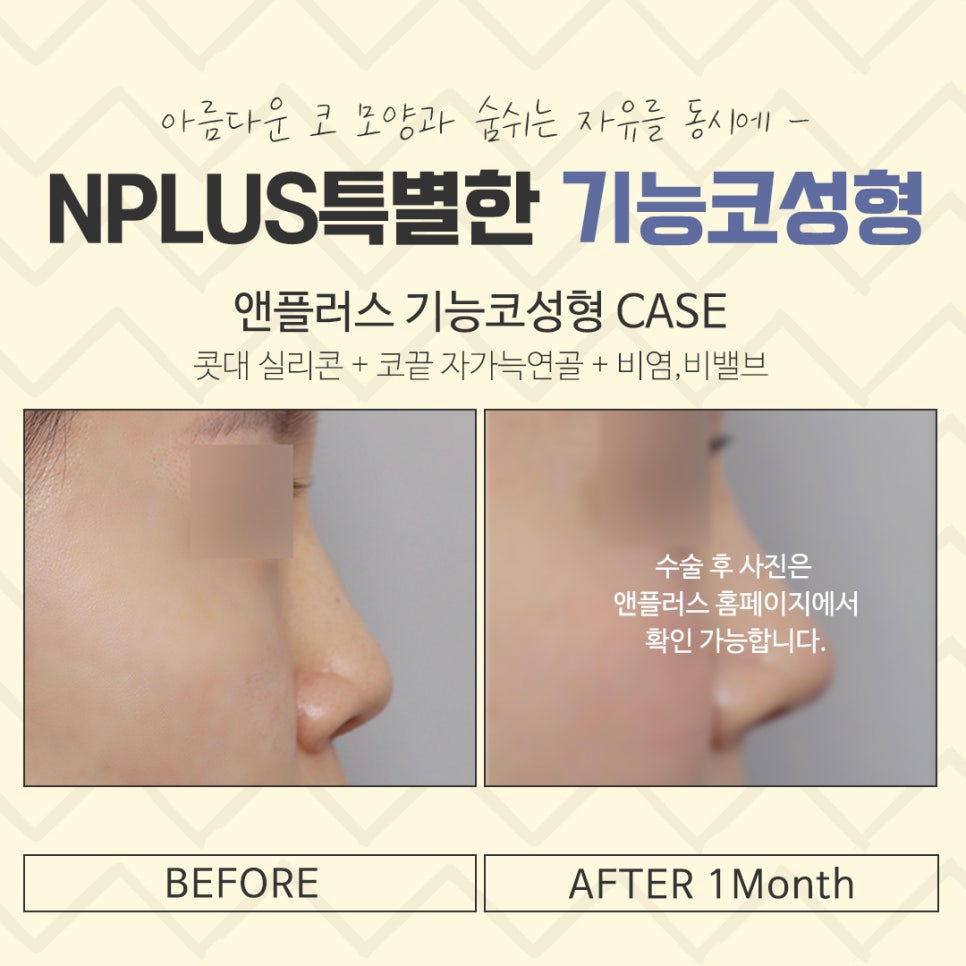Functional Rhinoplasty Review at a Top Gangnam Nose Surgery Clinic image 15