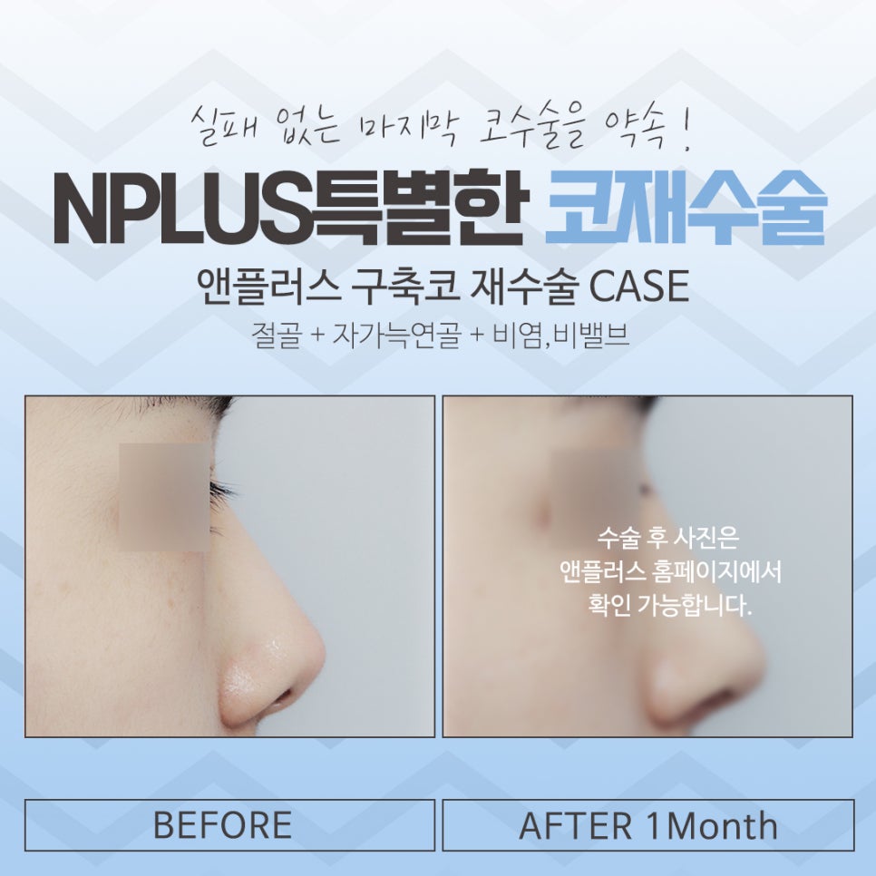 Carefully Check the Revision Rhinoplasty Hospital image 12