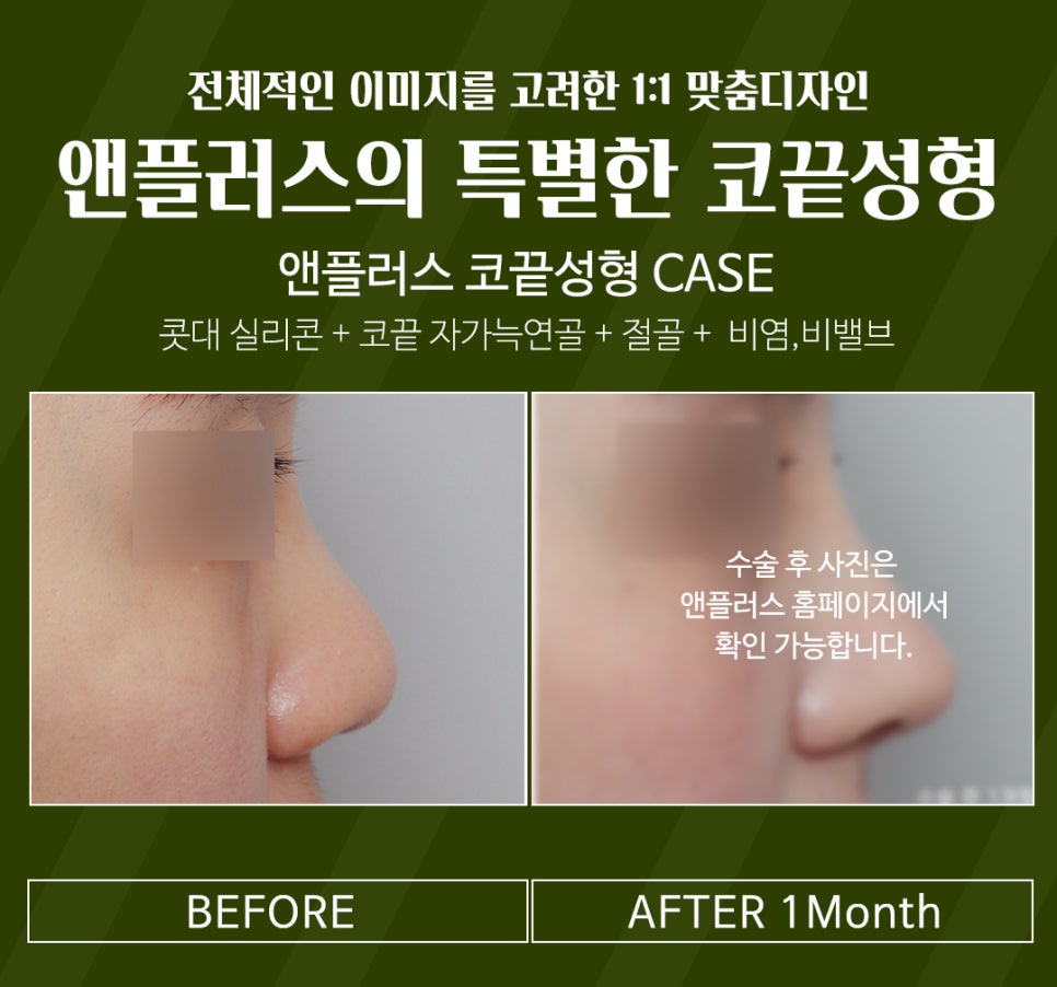 강남코성형 예쁜 코끝성형으로 이미지 개선 관련 이미지 1