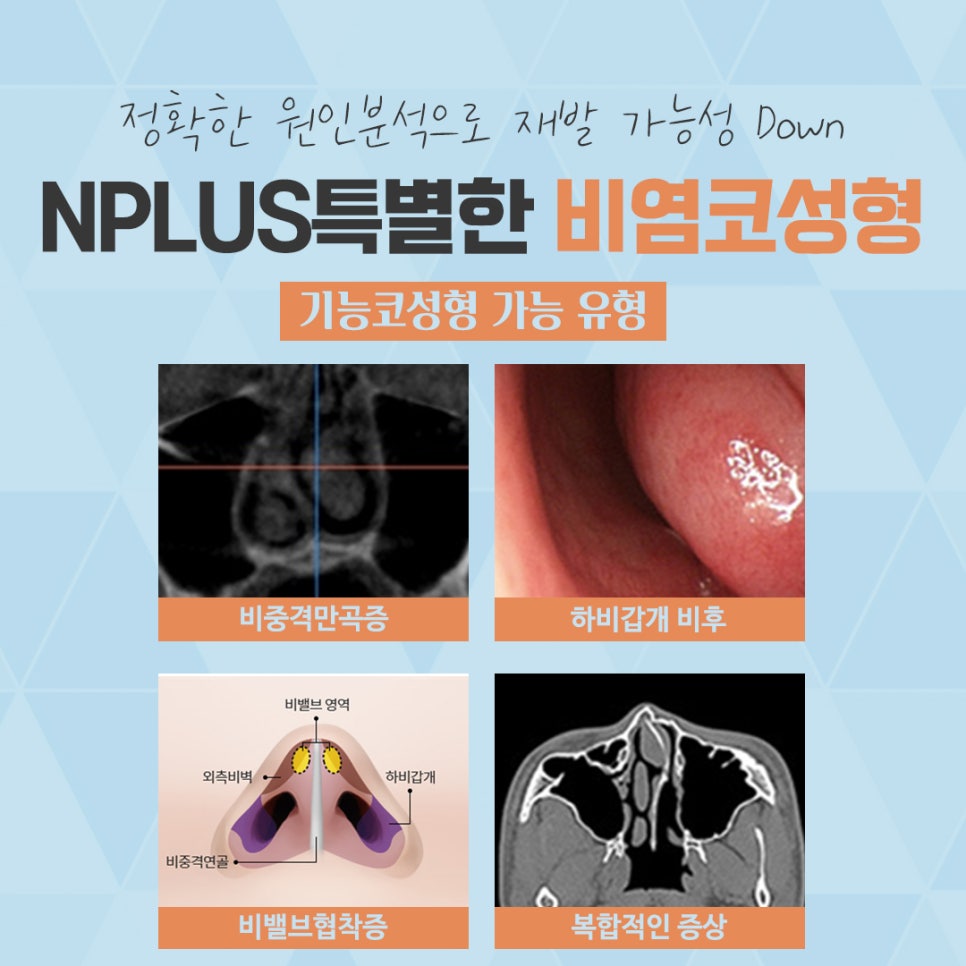 비염수술코성형 한 번의 선택으로 관련 이미지 6