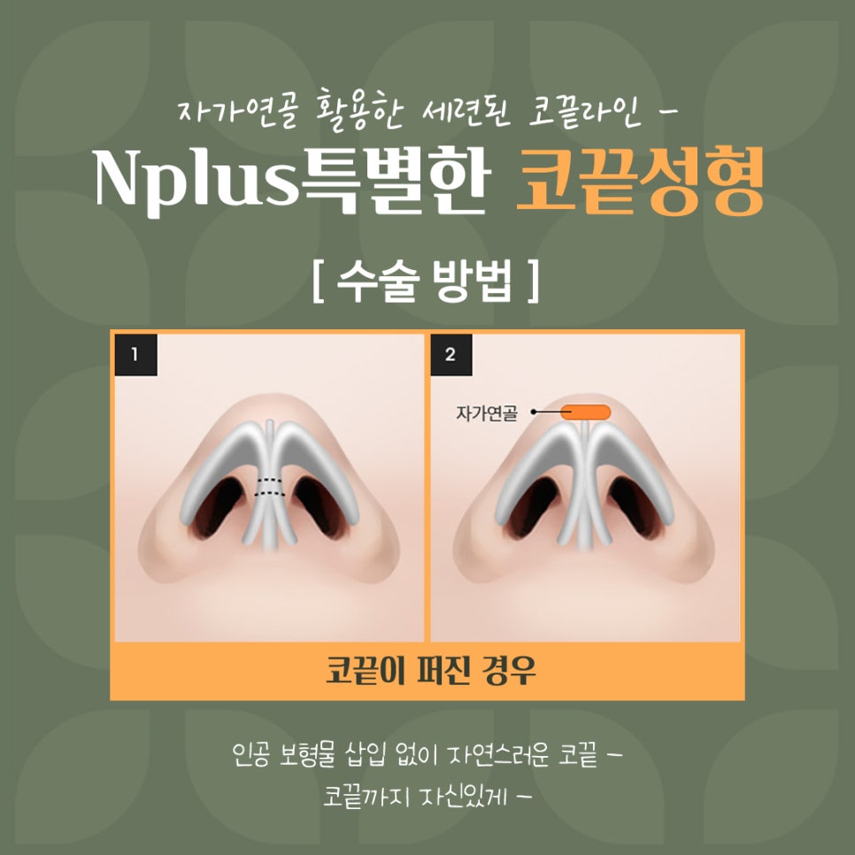 코끝성형으로 자연스럽게 예뻐지자 관련 이미지 11