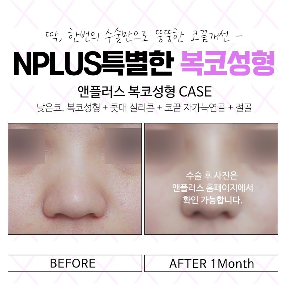 복코수술후기 자연스럽고 예쁜 라인으로 관련 이미지 15