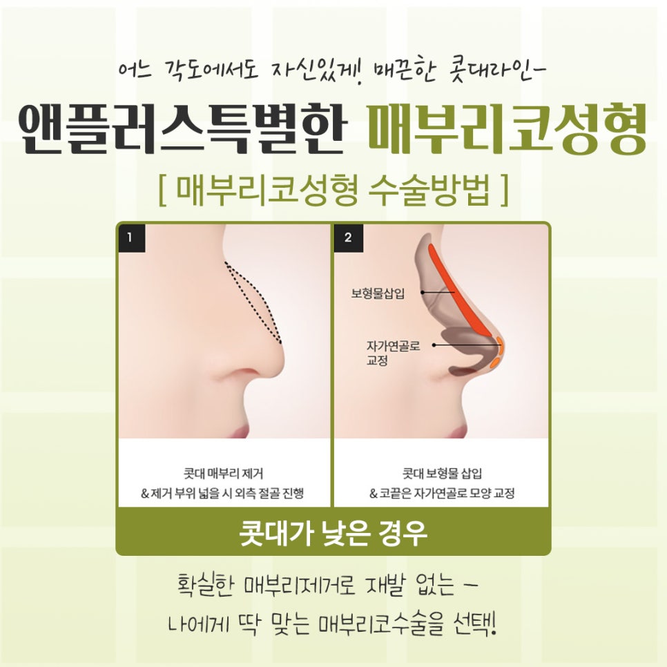 If You’re Looking for Reviews of Hump Nose Surgery image 10
