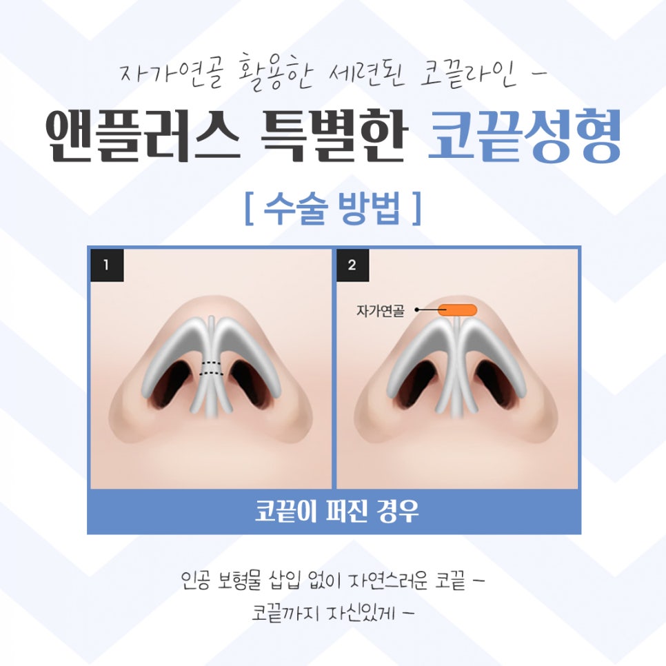코끝성형 후기까지 확인하고 관련 이미지 11