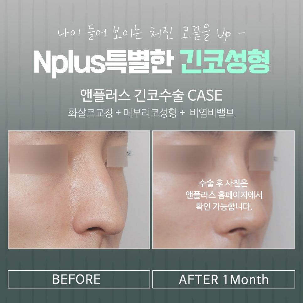 긴코수술을 통해 동안으로 관련 이미지 16