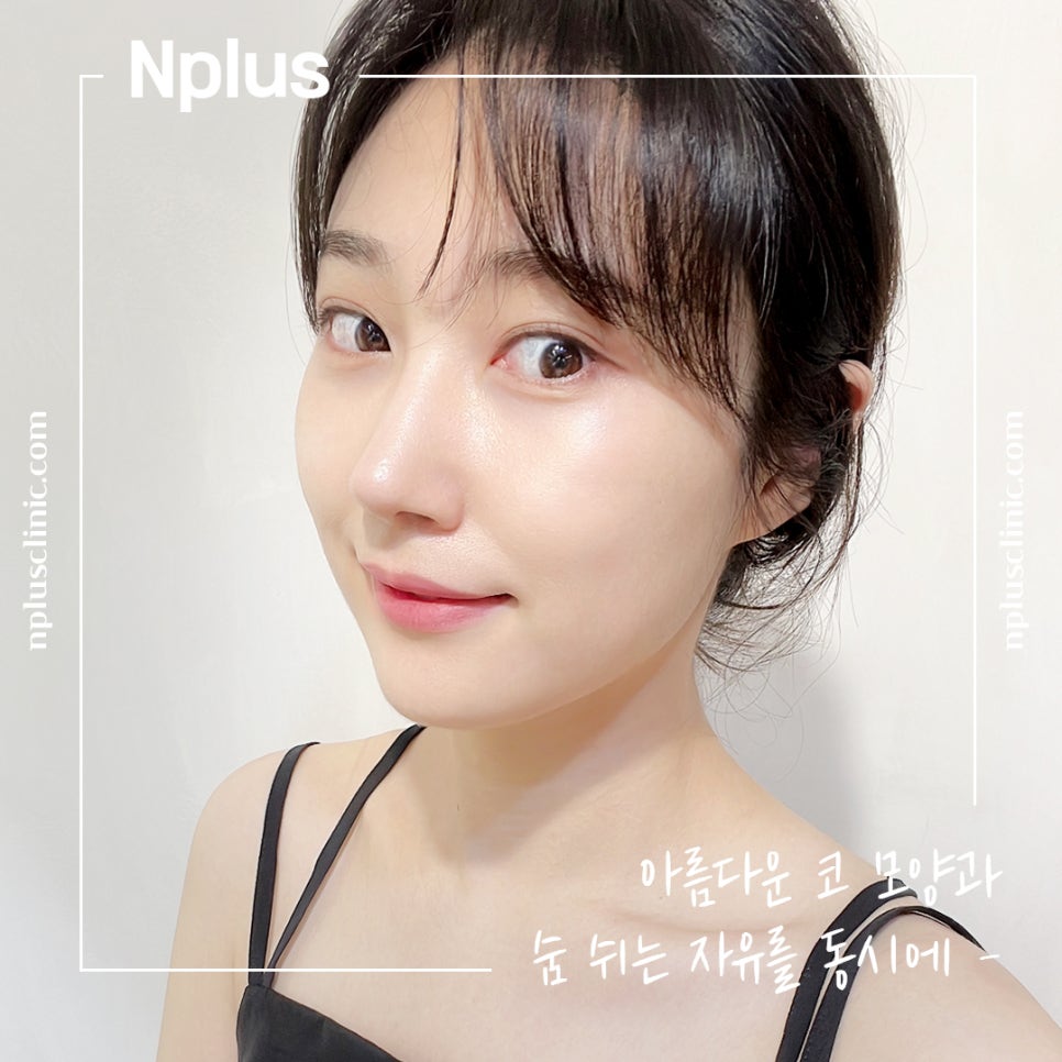 Before and After Nose Surgery: Looking into It Carefully image 2
