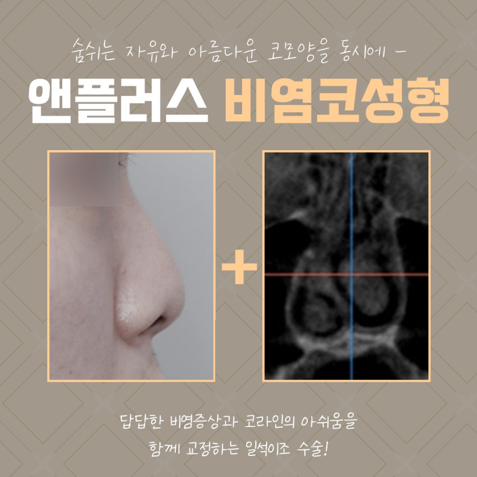 The Importance of Choosing a Rhinoplasty Review for Rhinitis image 3