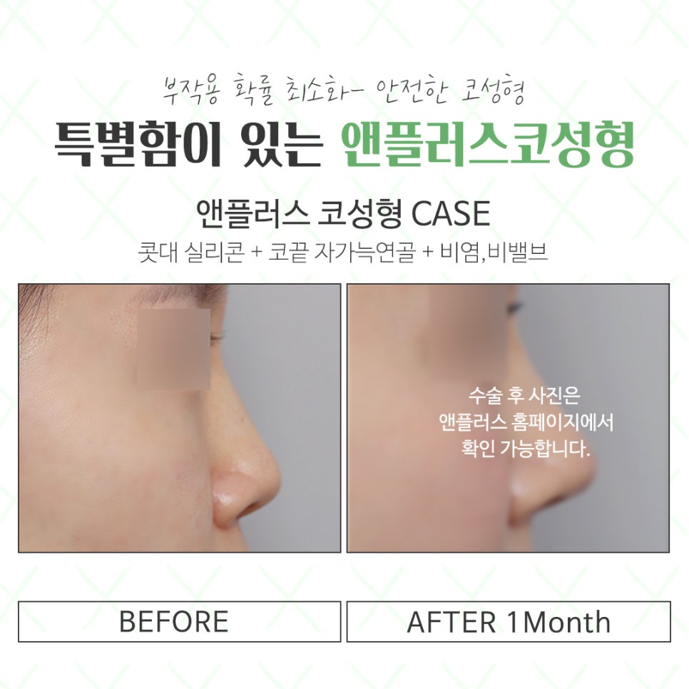 Check Rhinoplasty Reviews for a Natural and Beautiful Result image 4