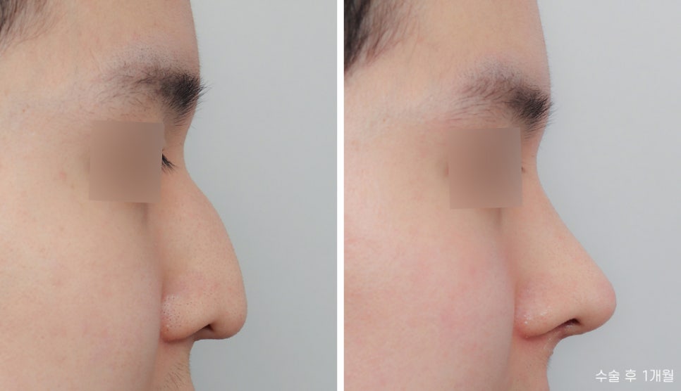 Hooked Nose Before-and-After Photos for a Softer Look image 5