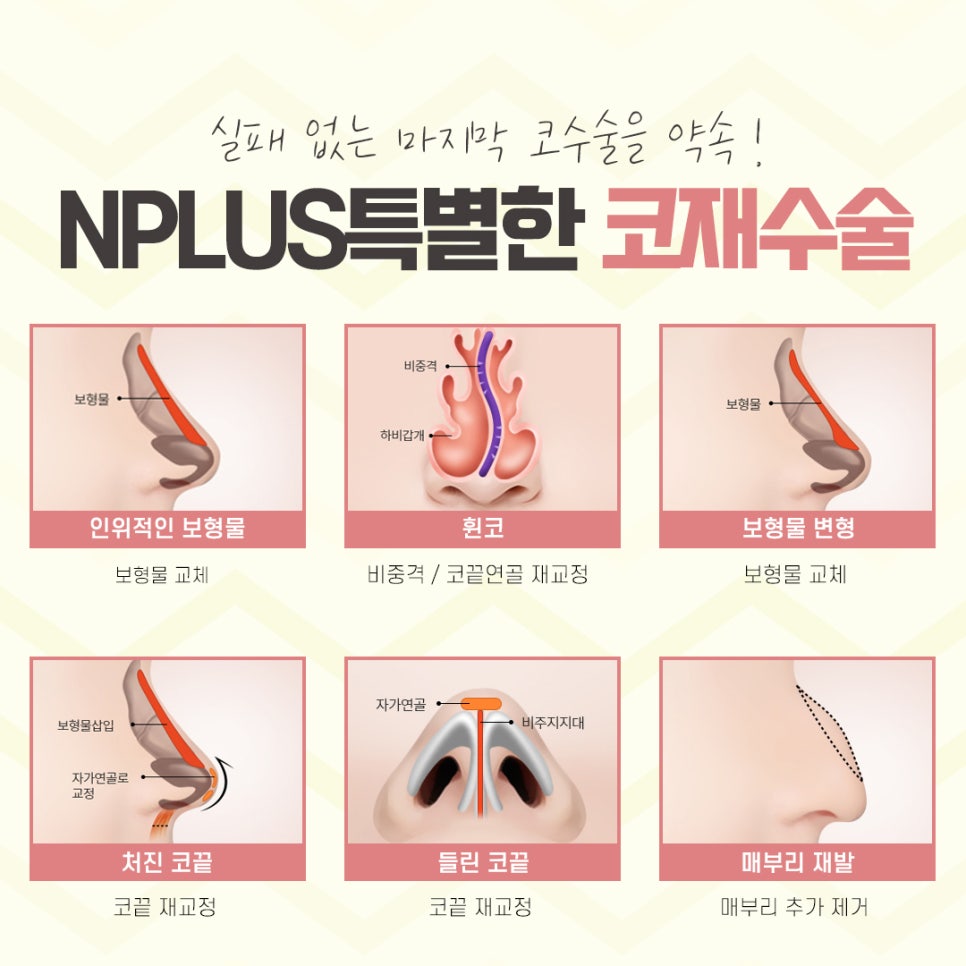 코재수술성형외과 차이를 알아보고 관련 이미지 9