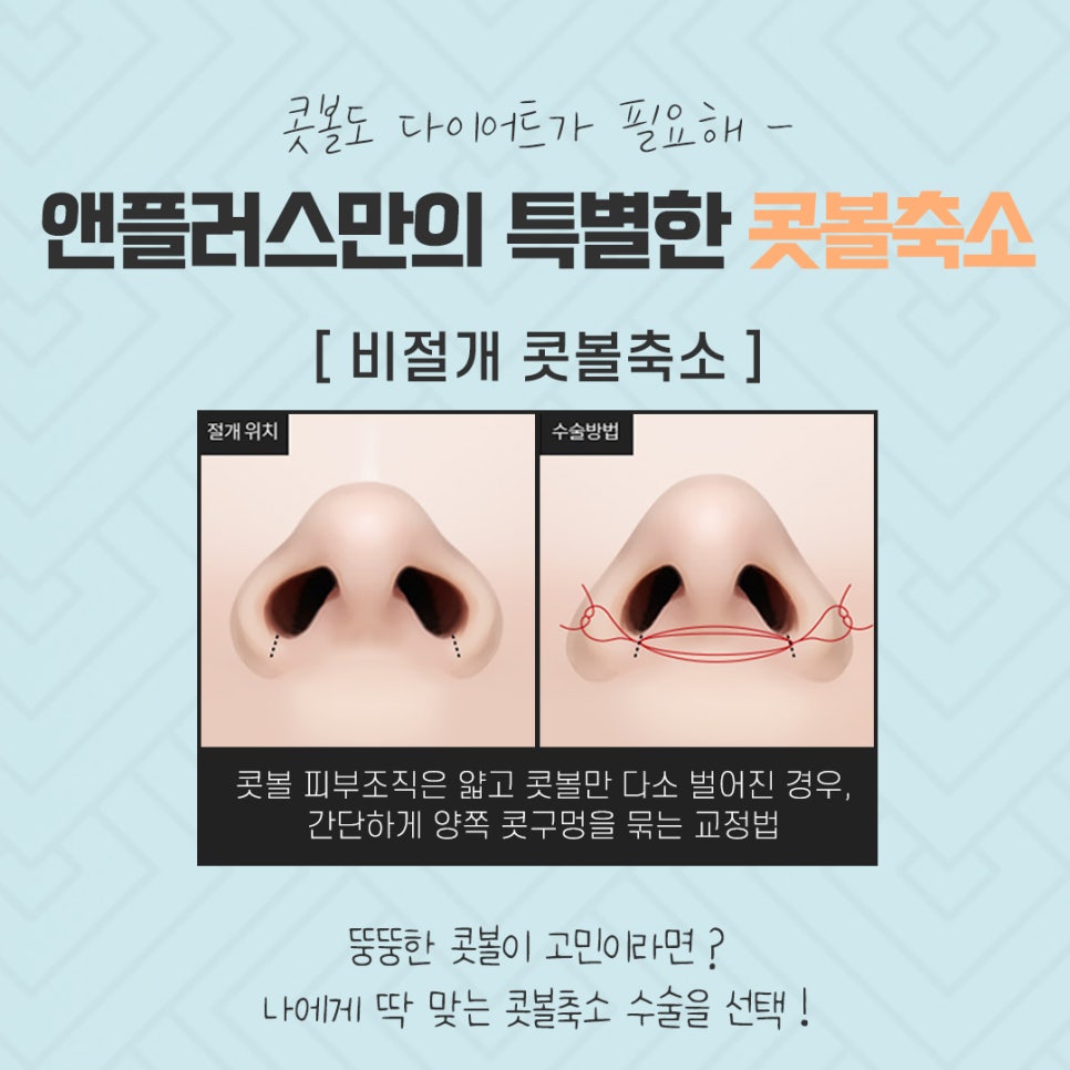 콧볼축소수술 흉터 없이 강남앤플러스에서! 관련 이미지 9