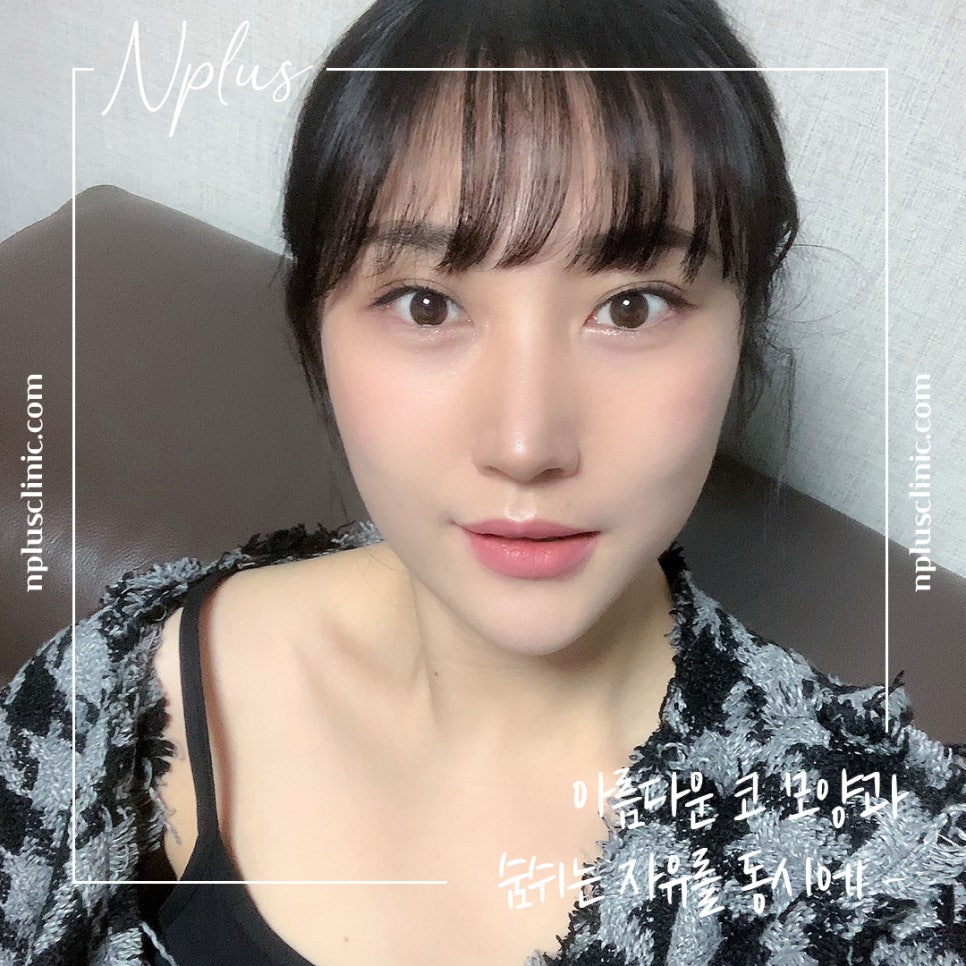 Reviewing Nostril Reduction Results and Improving Your Appearance image 2