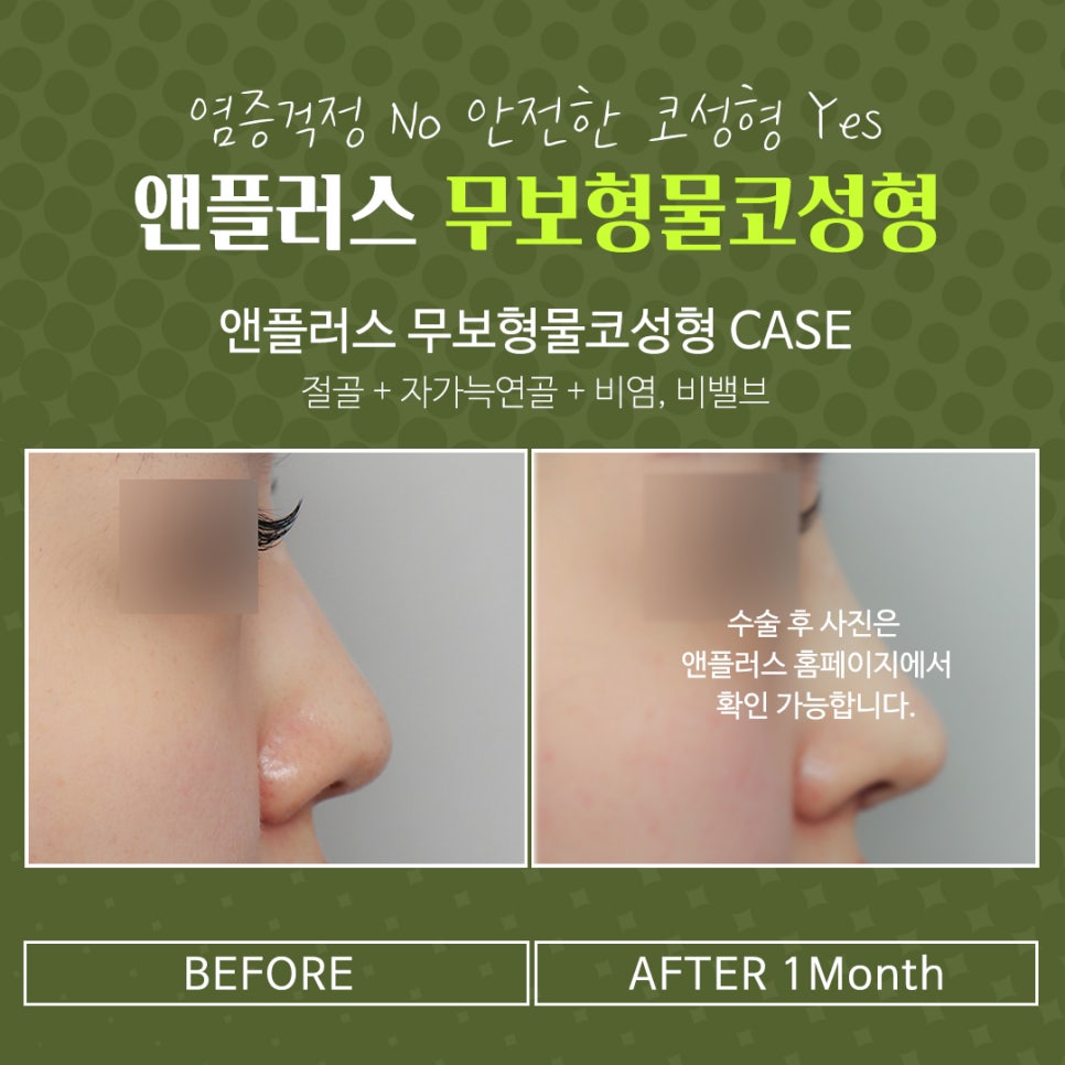 자가연골 활용한 코수술후기 관련 이미지 3