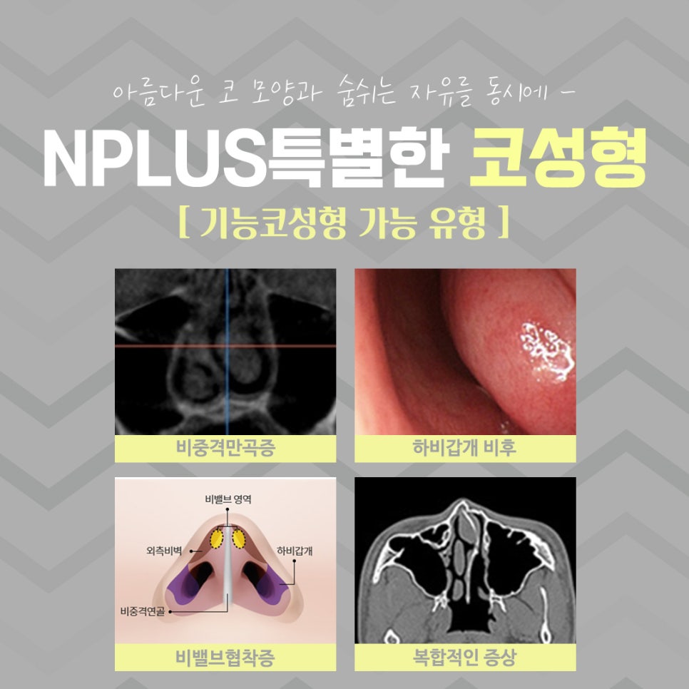 코수술전후 확실한 변화로 관련 이미지 6