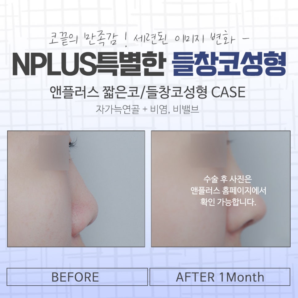 들창코성형 후기를 비교해 보고 관련 이미지 15