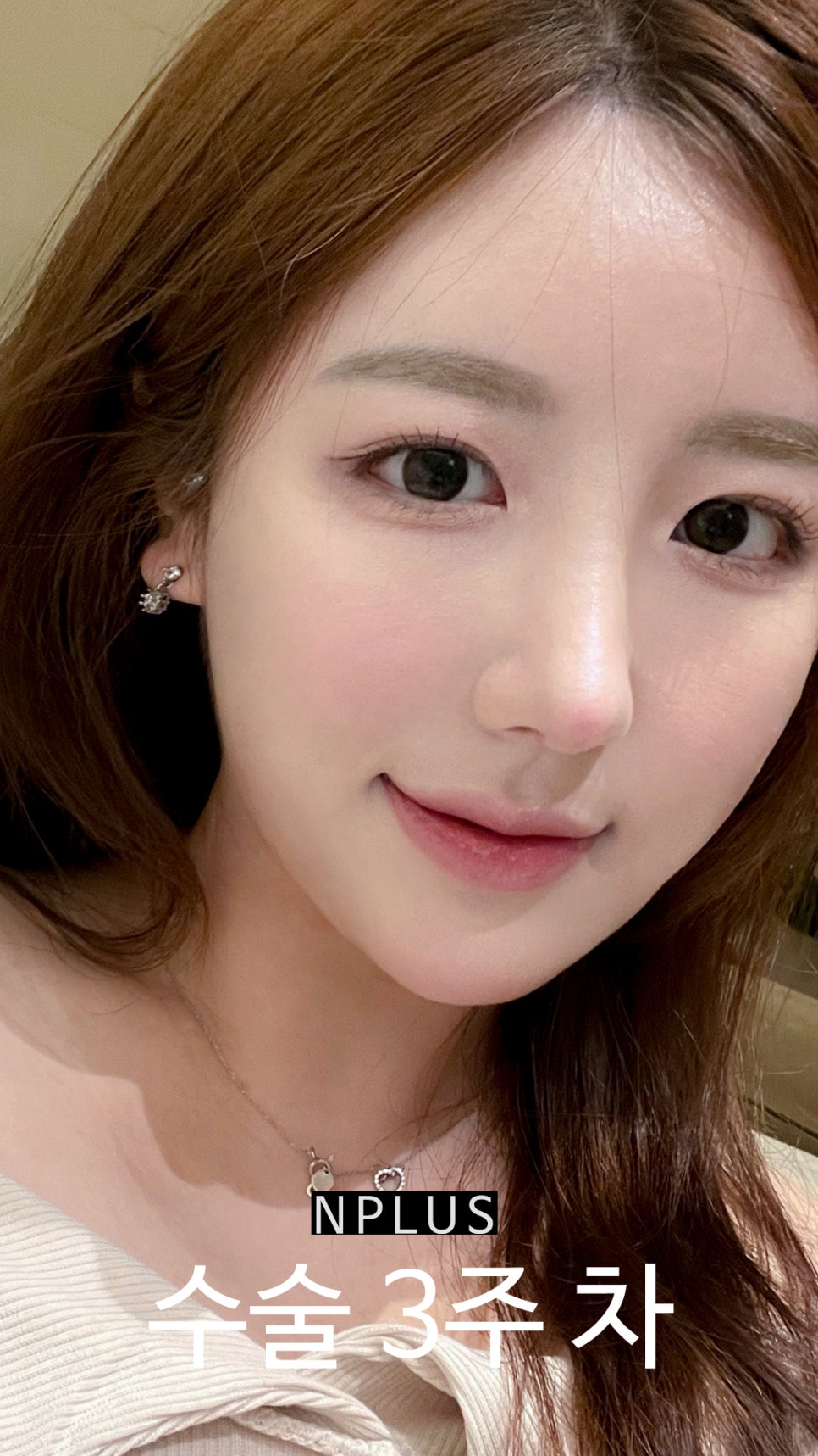 Short and Upturned Nose Shape Corrected with Autologous Rib Cartilage Nose Surgery at N Plus Clinic! image 6