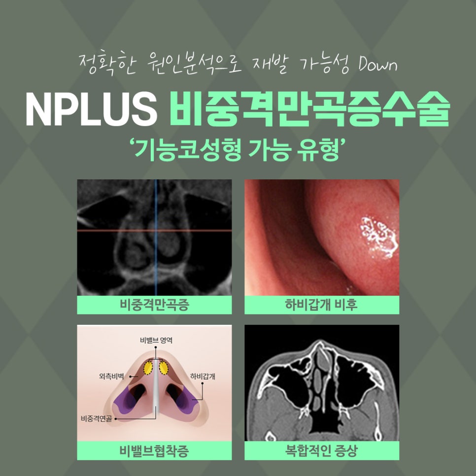 비중격코수술 원인 파악을 확실하게 관련 이미지 5