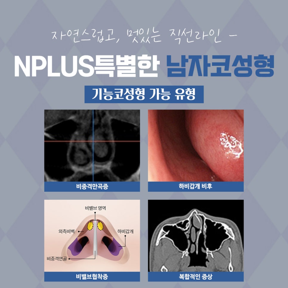 Where to Get Male Rhinoplasty Done Well: Natural and Refined image 6