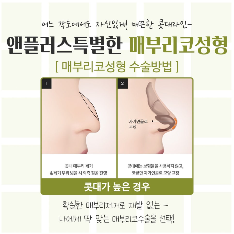 매부리코성형후기 정확한 진단을 통해 관련 이미지 9