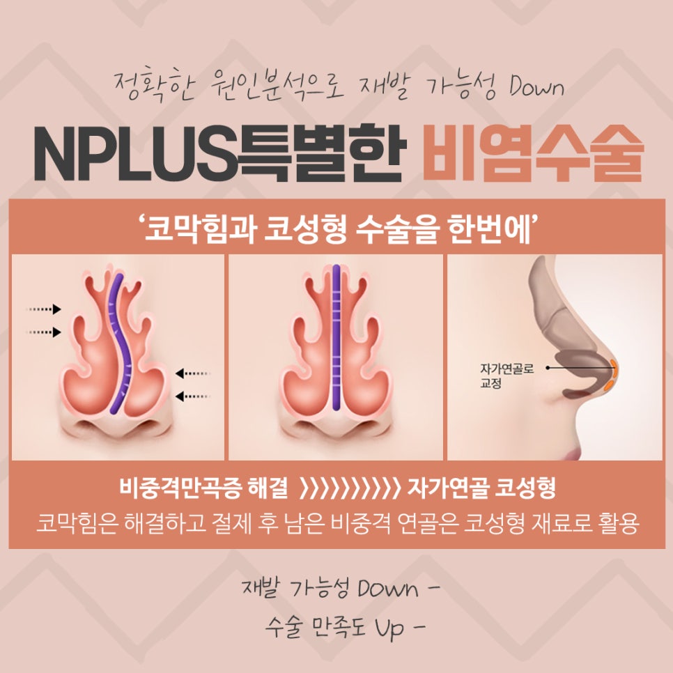 비중격수술후기 정확하게 파악해야 관련 이미지 10