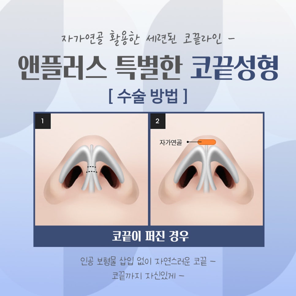 Looking Into Tip Rhinoplasty Reviews in Detail image 11