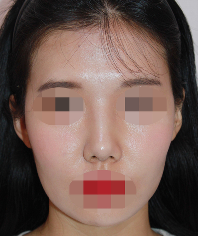 1_여자 매부리코 수술전후 관련 이미지 7