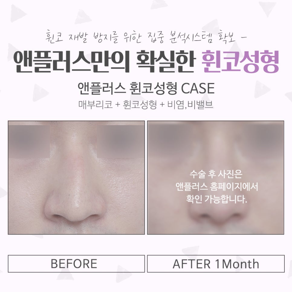 휜코성형후기 기능까지 확인해야 관련 이미지 16