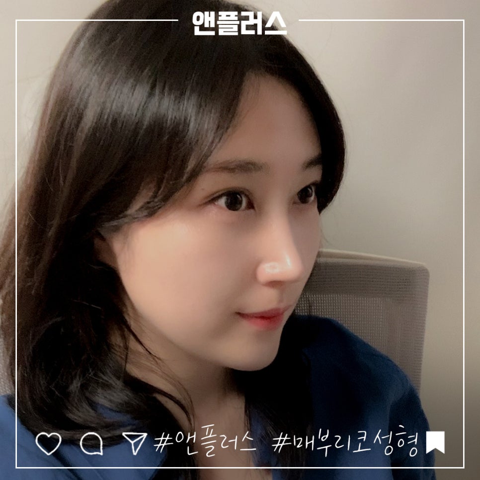 매부리코성형후기 꼼꼼하게 알아보고 관련 이미지 8