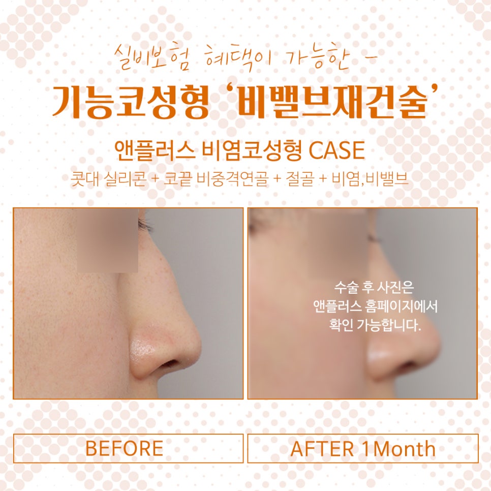 비밸브협착증 코수술방법 완벽 정리 관련 이미지 8