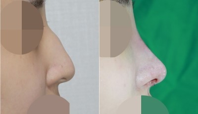 압구정 앤플러스성형외과 : 매부리코성형 수술전후 관련 이미지 1