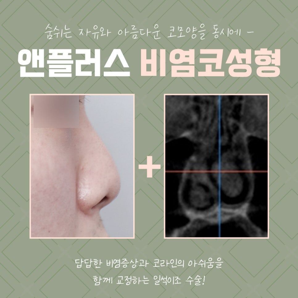 비염코성형후기 라인까지 고려하여 관련 이미지 3