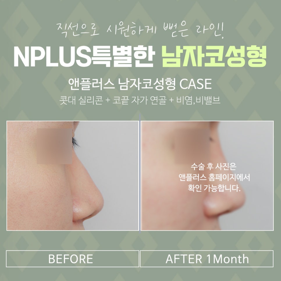 남자코수술후기 정확한 진단으로 관련 이미지 15