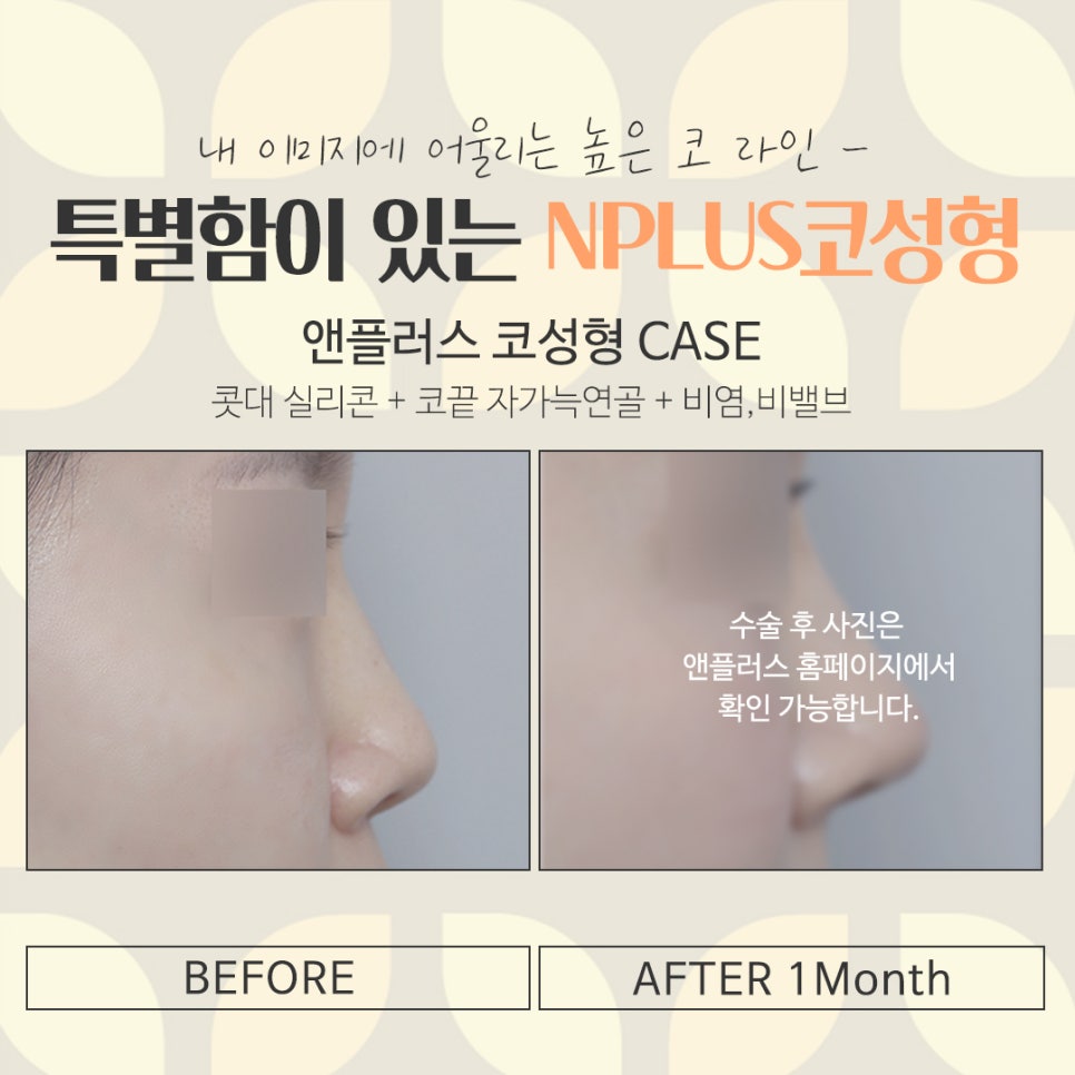 Looking into Reviews of Female Rhinoplasty in Detail image 17