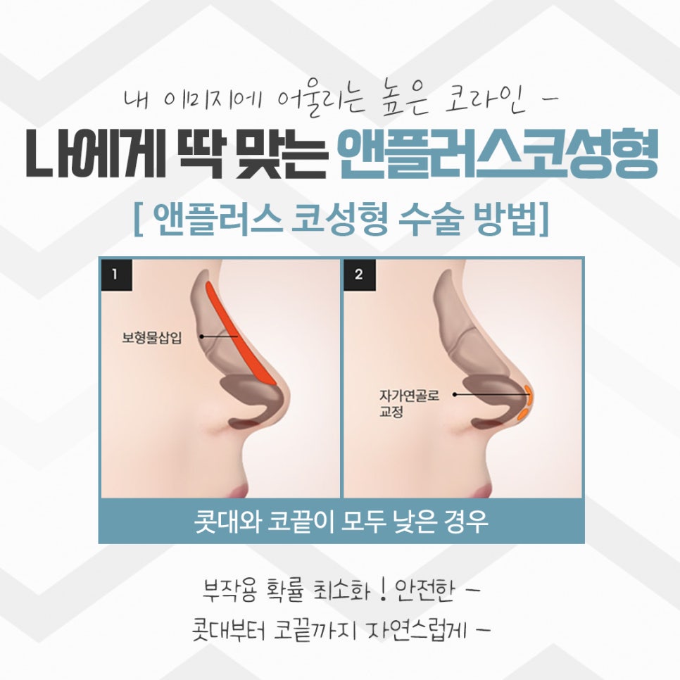 Rhinoplasty Review: Improved with a Refined Line image 8