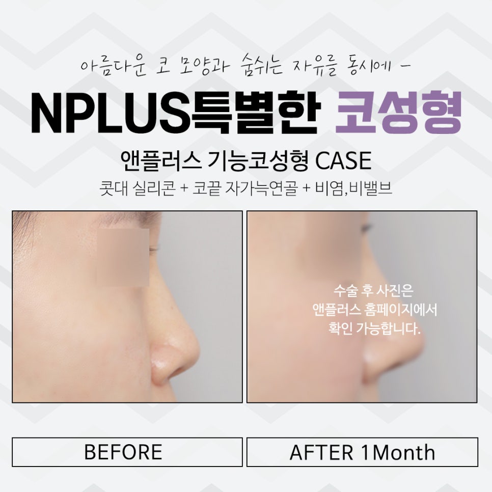 Before and After Nose Surgery: Looking into It Carefully image 15