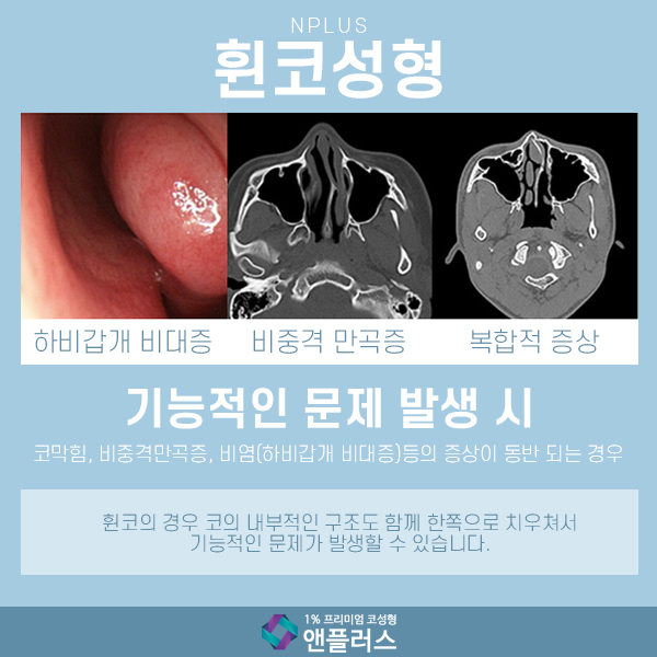 Crooked Nose Surgery at N+ image 2