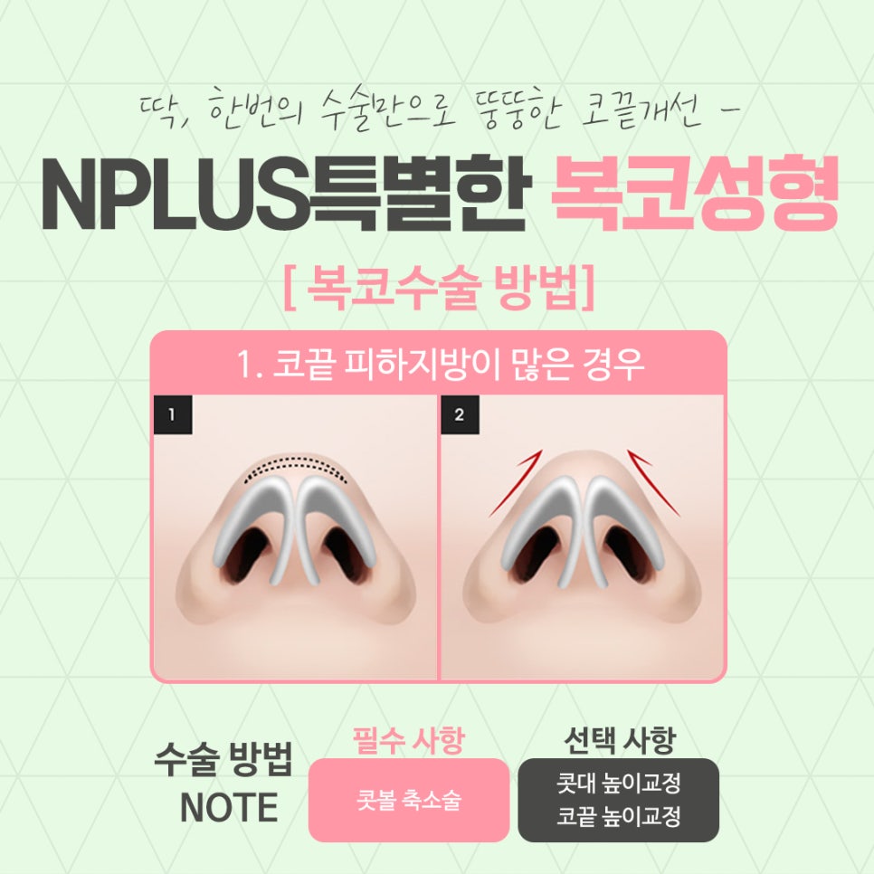 Before and After Bulbous Nose Surgery: Accurately Identifying the Cause image 7