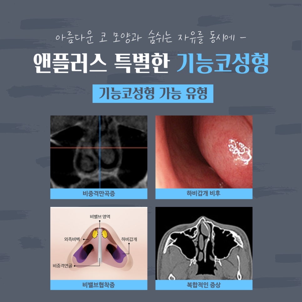 Rhinoplasty Review That Also Improved Function image 5