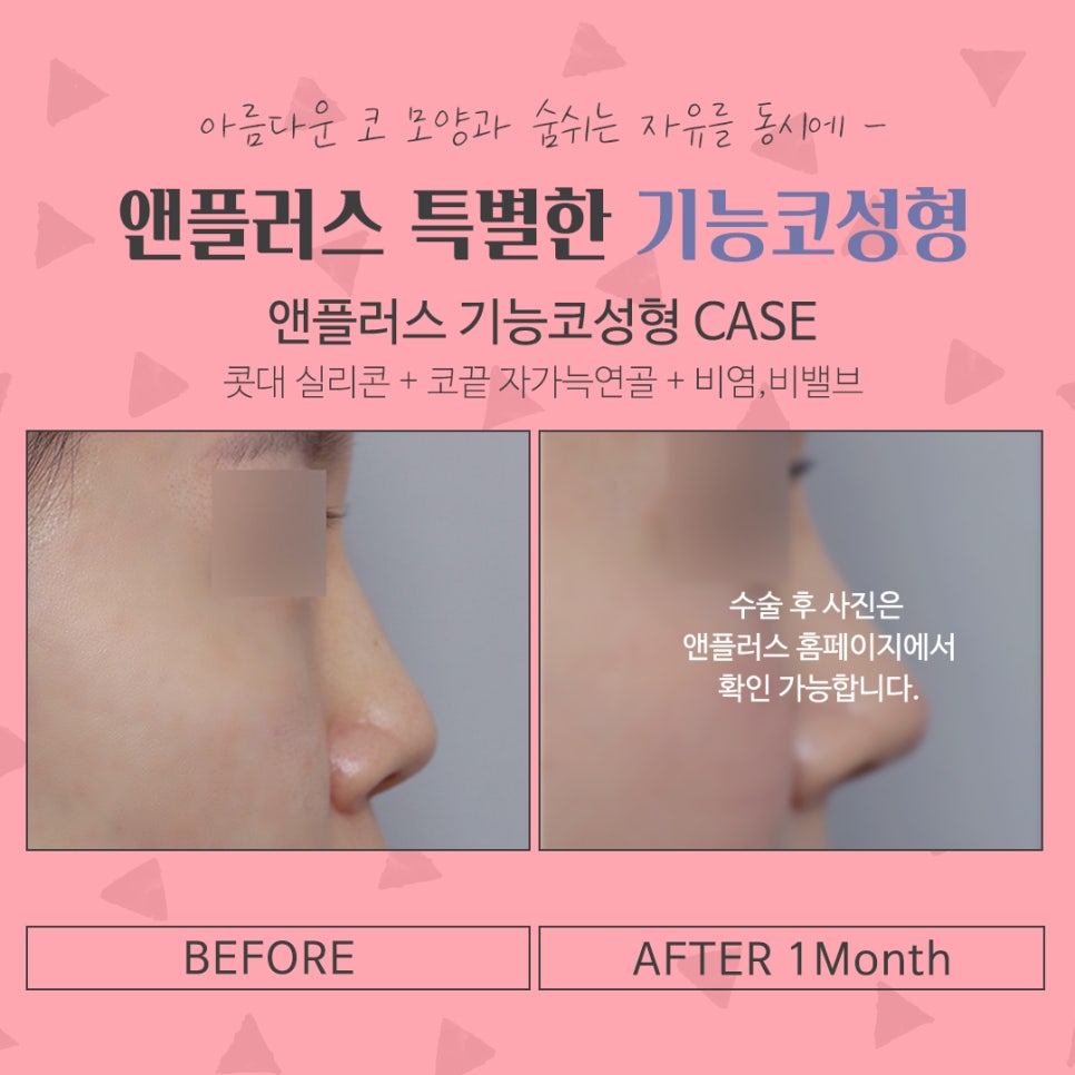 코수술후기 비중격만곡증까지 확인하여 관련 이미지 13