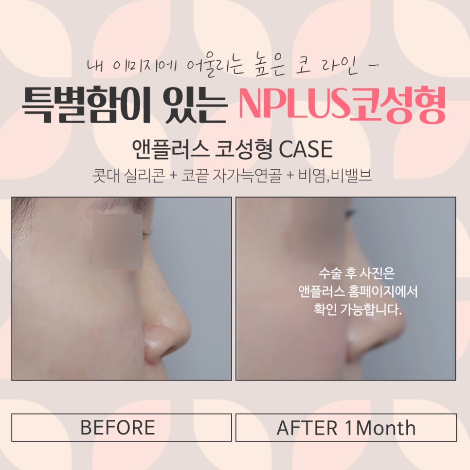여자코수술후기 정확한 진단으로 관련 이미지 17