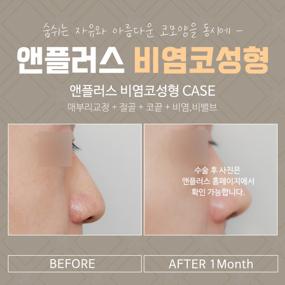 The Importance of Choosing a Rhinoplasty Review for Rhinitis image 14