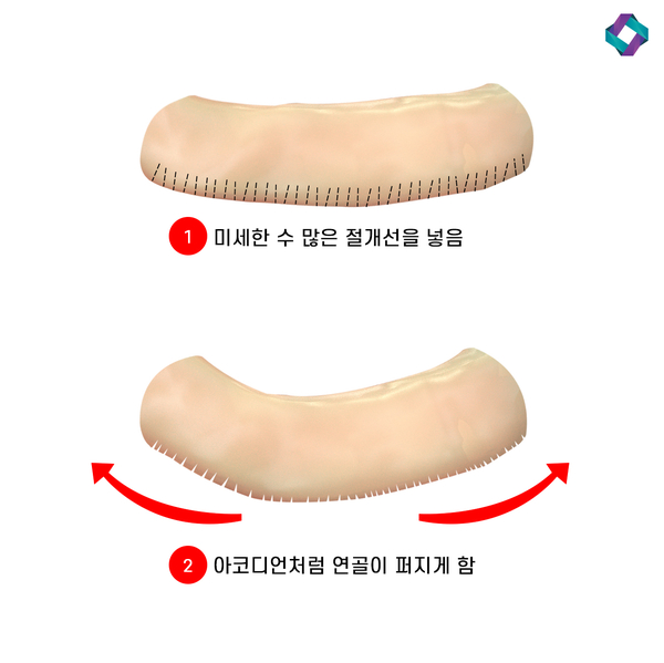 늑연골 코성형 : 자가연골의 장점과 단점 (자가연골 비교) 관련 이미지 10