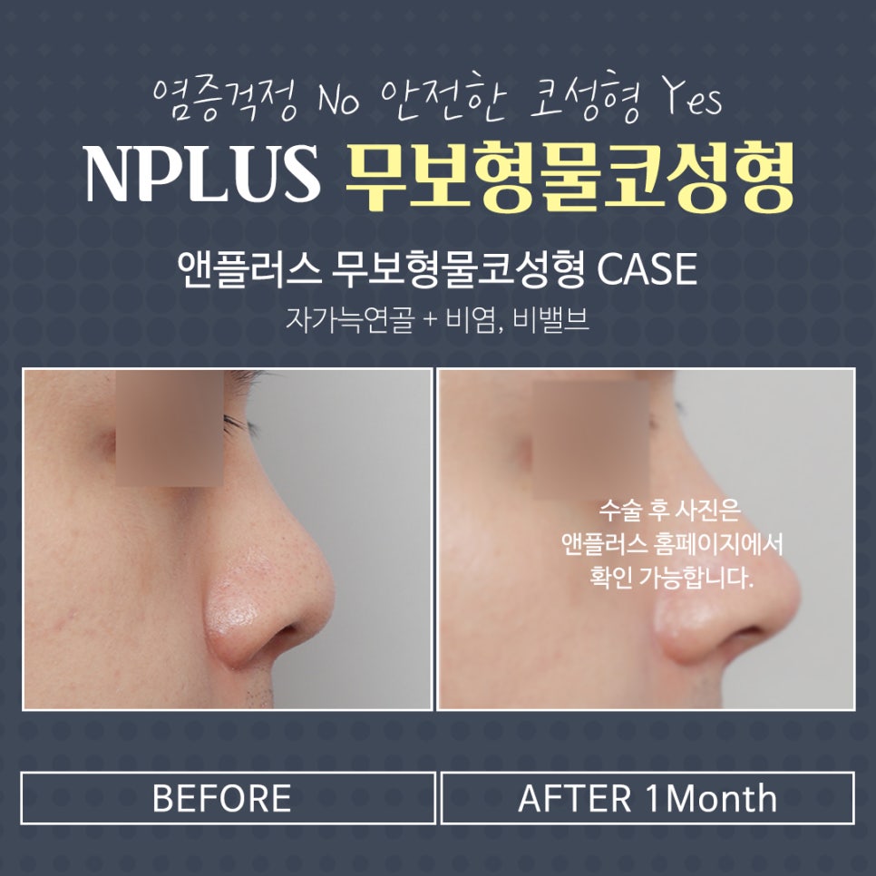 Non-Implant Nose Surgery Using Autologous Cartilage image 13